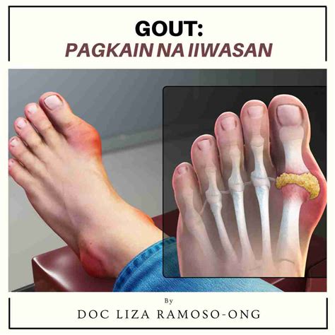 sintomas ng gout sa paa|Gout .